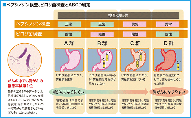 胃がんを予防するピロリ菌検査